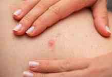 Tarija: médico recomienda hábitos clave para prevenir la foliculitis y evitar complicaciones en la piel